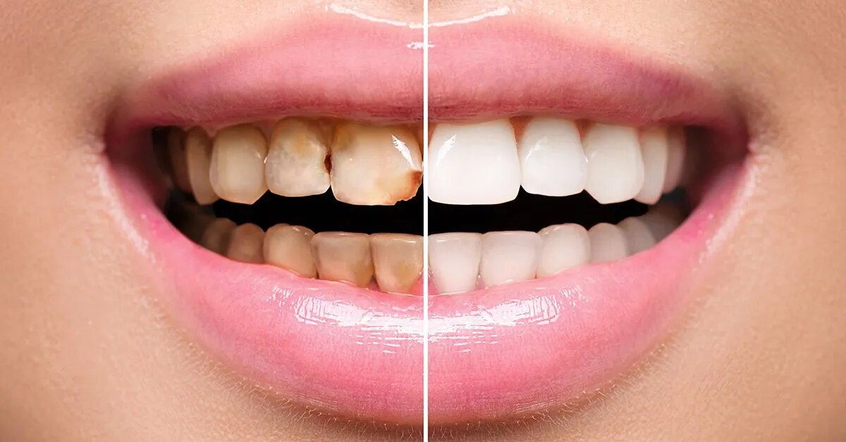 Dental Veneers: Enhancing Your Smile